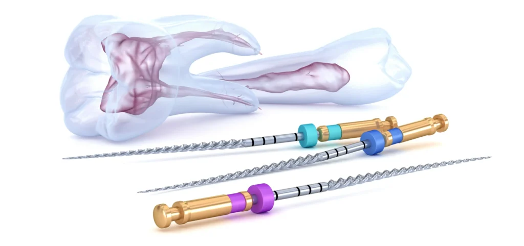 Endodontie | Dévitalisation et retraitement endodontique