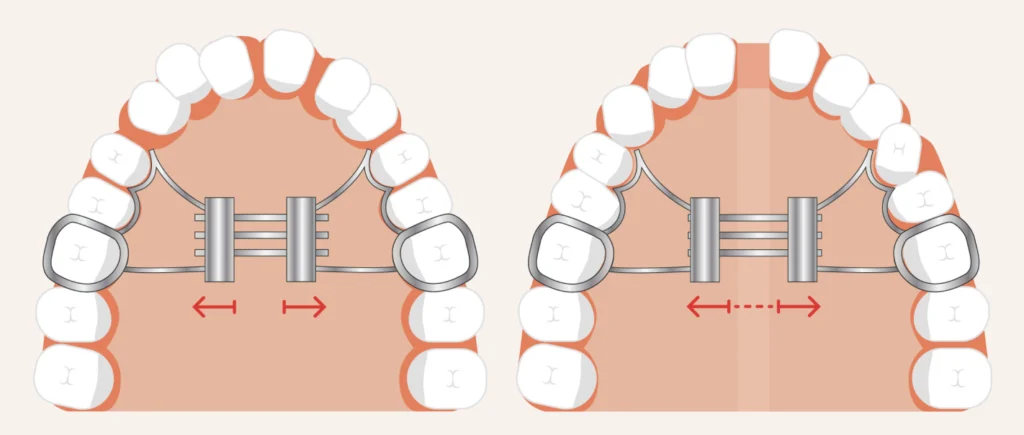 expansion palatine Orthodontie enfant Dr Kévin MAHOUN - Orthodontiste à Rungis