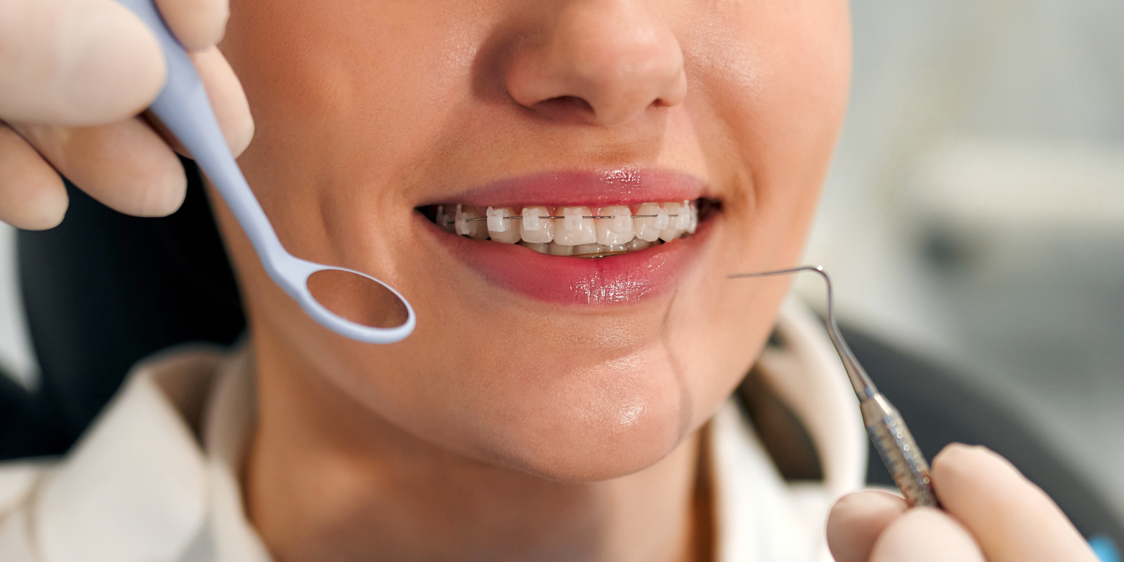 orthodontie adolescent appareils multi attaches Orthodontie adolescent Dr Kévin MAHOUN - Orthodontiste à Rungis