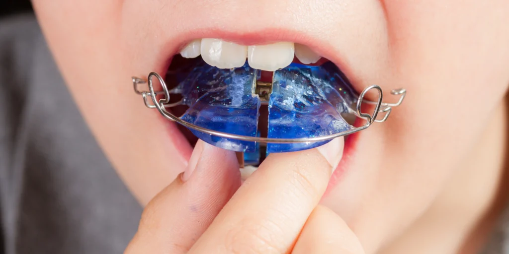 orthodontie enfants plaque palatine Traitements Dr Kévin MAHOUN - Orthodontiste à Rungis