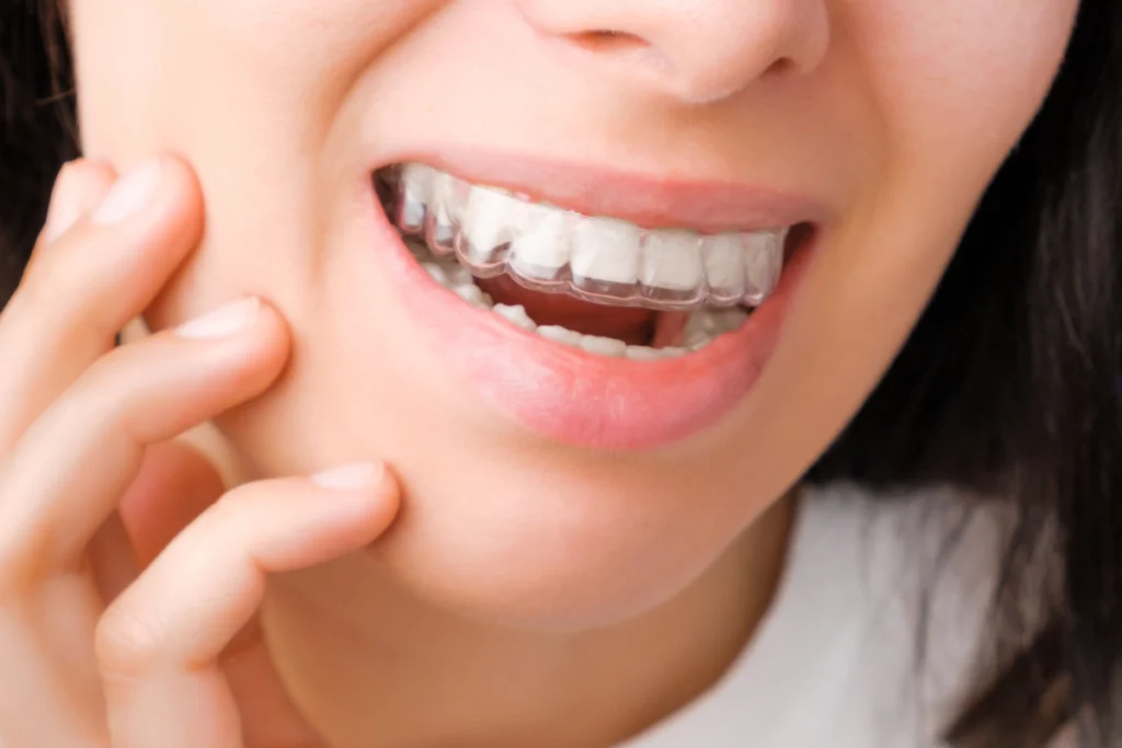 orthodontie invisible aligneurs transparents Orthodontie adulte Dr Kévin MAHOUN - Orthodontiste à Rungis