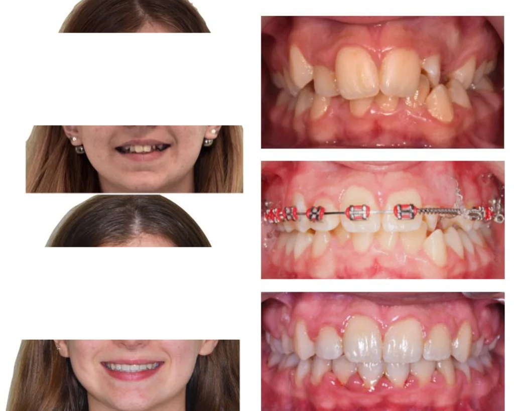 cas clinique orthodontie rungis Photos cas avant/après Dr Kévin MAHOUN - Orthodontiste à Rungis