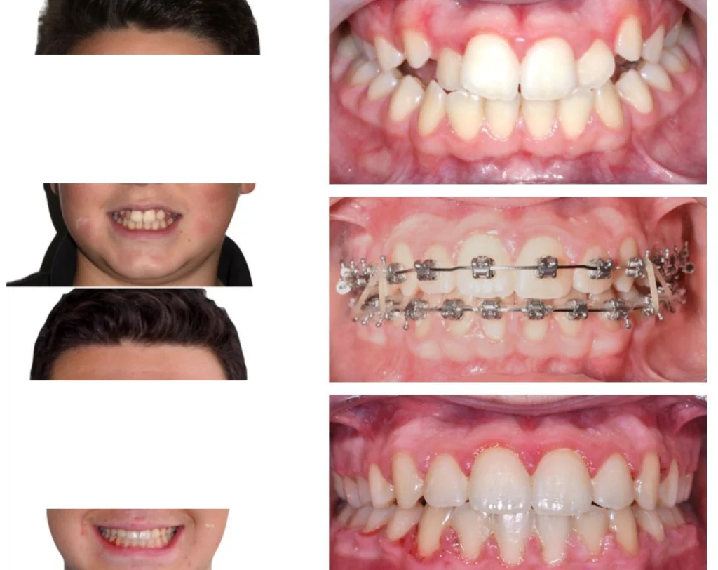 cas clinique orthodontie rungis Photos cas avant/après Dr Kévin MAHOUN - Orthodontiste à Rungis