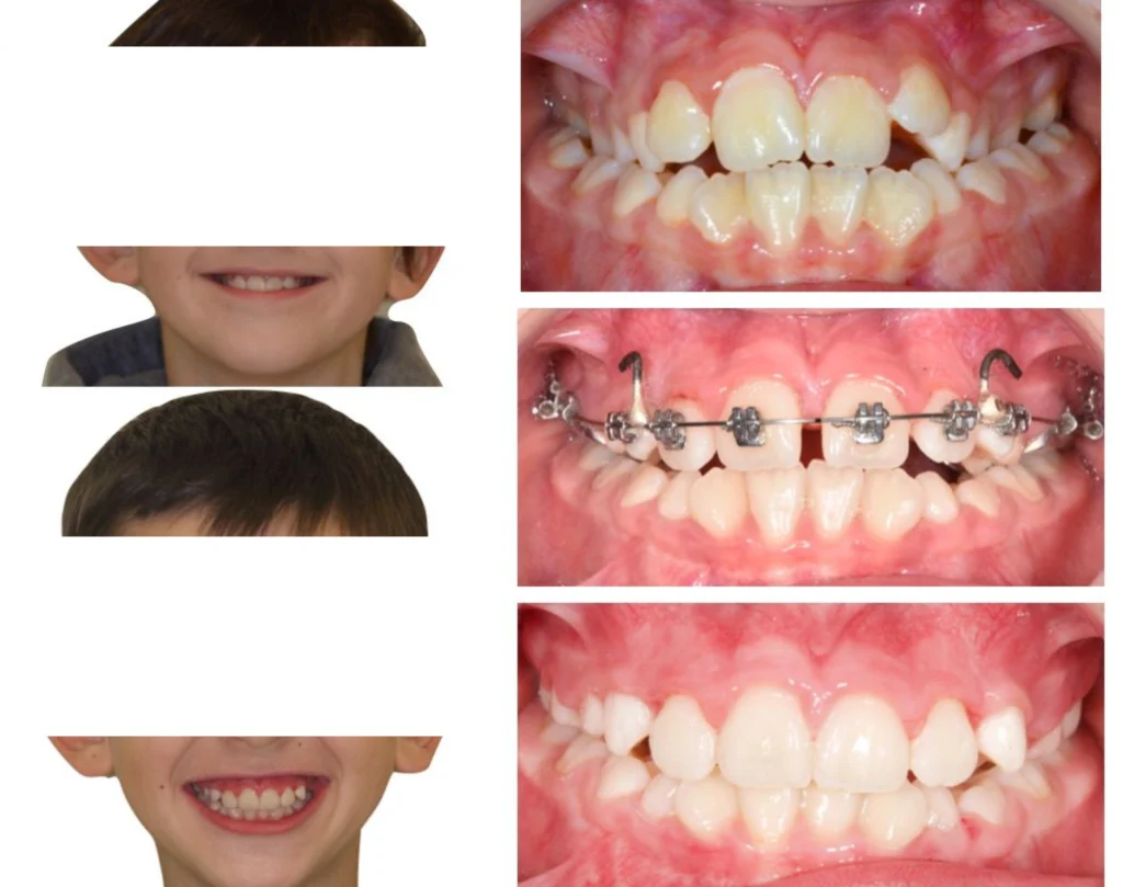 cas clinique orthodontie rungis Photos cas avant/après Dr Kévin MAHOUN - Orthodontiste à Rungis