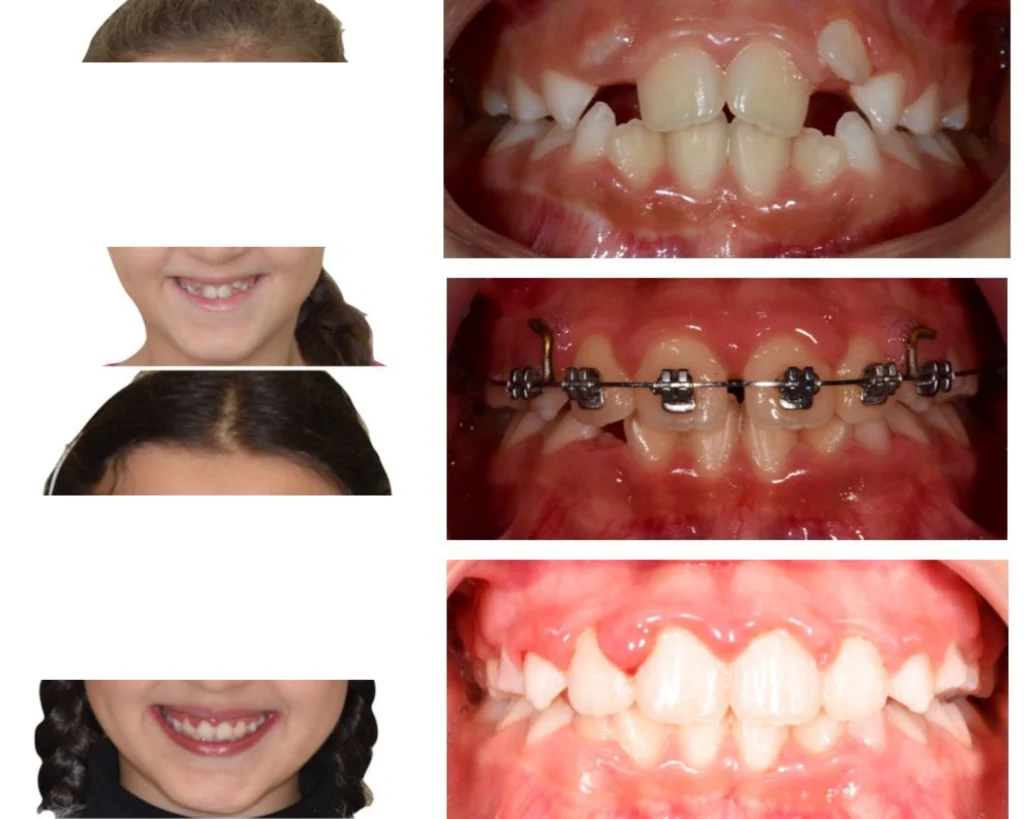 cas clinique orthodontie rungis Photos cas avant/après Dr Kévin MAHOUN - Orthodontiste à Rungis