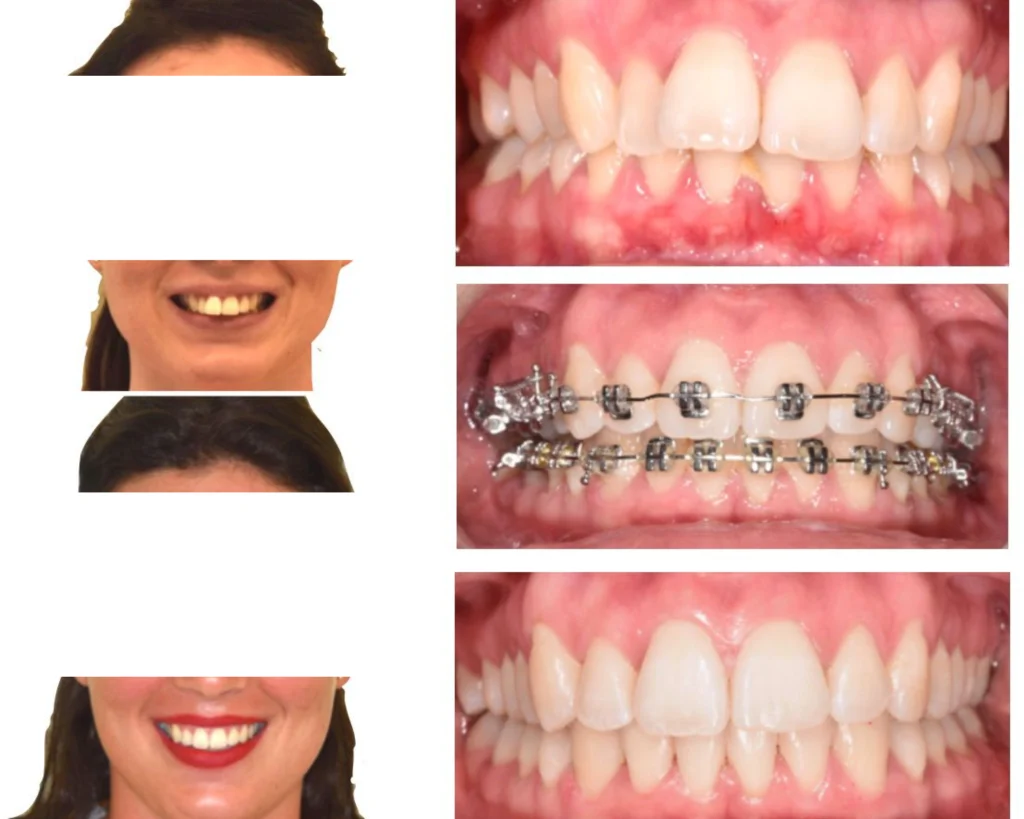 cas clinique orthodontie rungis Photos cas avant/après Dr Kévin MAHOUN - Orthodontiste à Rungis