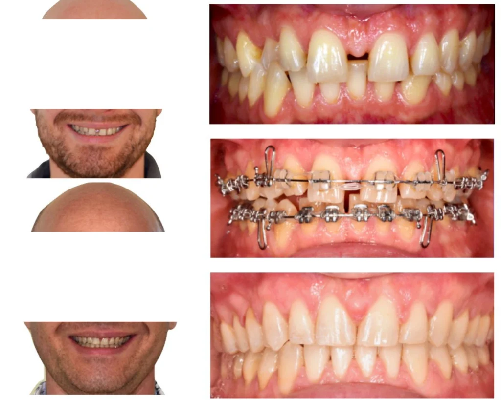 cas clinique orthodontie rungis Photos cas avant/après Dr Kévin MAHOUN - Orthodontiste à Rungis