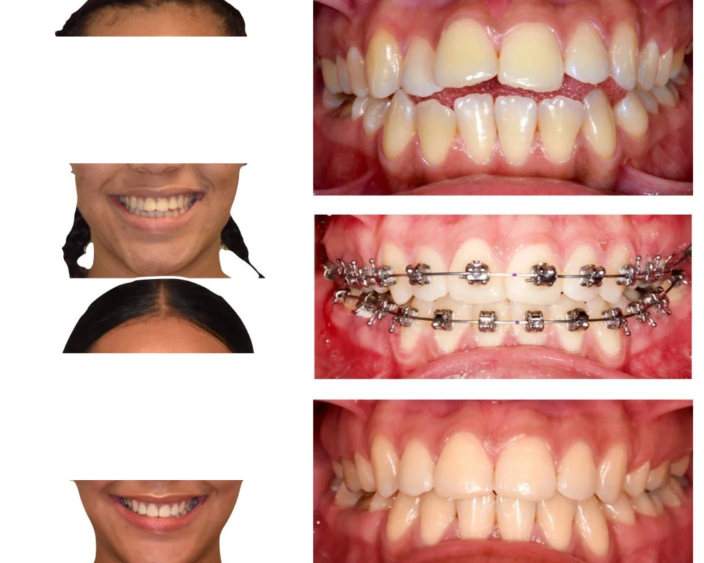 cas clinique orthodontie rungis Photos cas avant/après Dr Kévin MAHOUN - Orthodontiste à Rungis