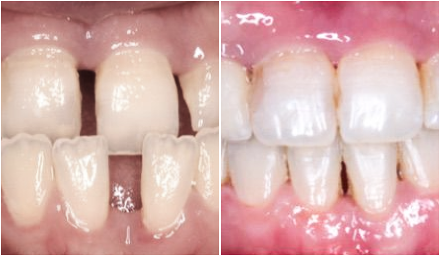 cas clinique orthodontie cas cliniques Dr Kévin MAHOUN - Orthodontiste à Rungis