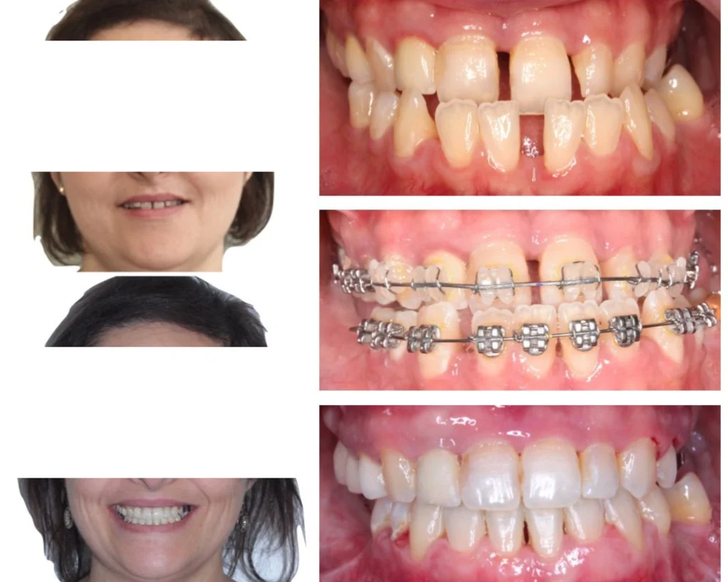 cas clinique orthodontiste rungis Photos cas avant/après Dr Kévin MAHOUN - Orthodontiste à Rungis