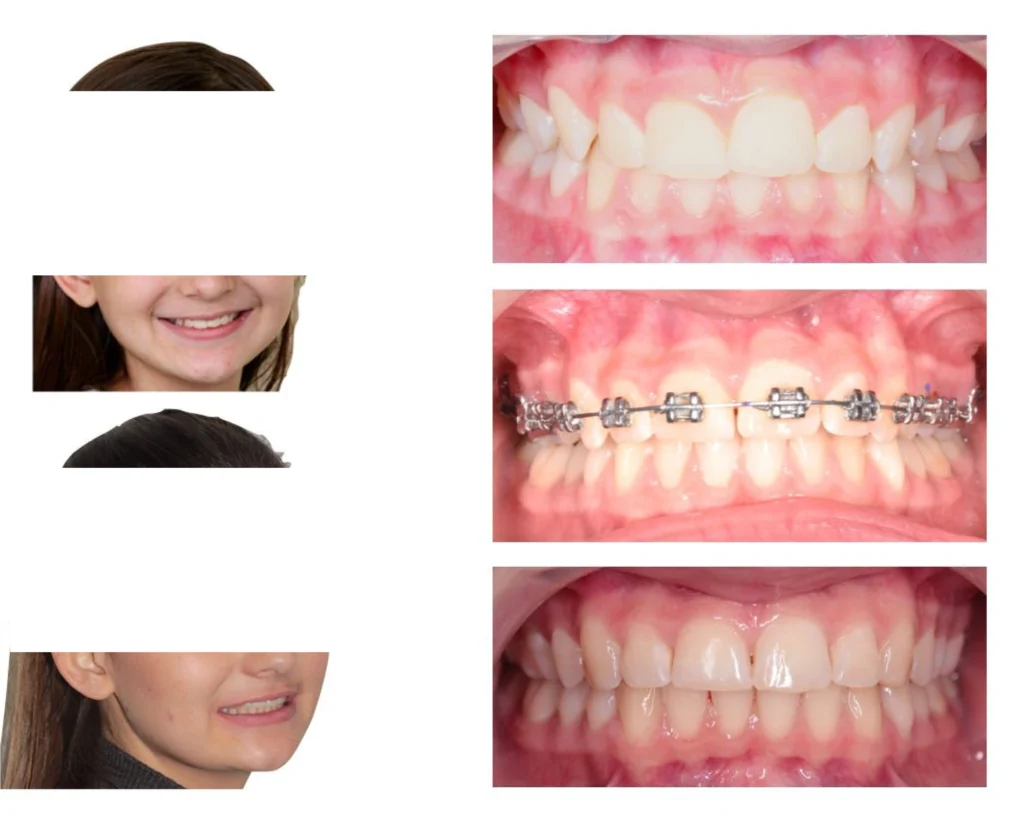 cas clinique orthodontiste rungis Photos cas avant/après Dr Kévin MAHOUN - Orthodontiste à Rungis