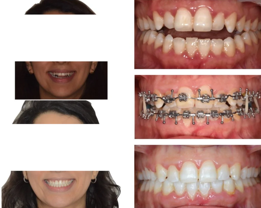 cas clinique orthodontiste rungis Photos cas avant/après Dr Kévin MAHOUN - Orthodontiste à Rungis