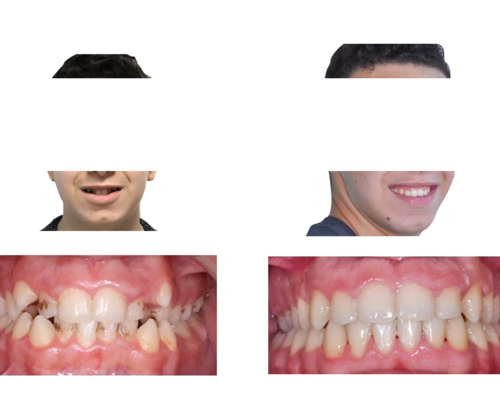 cas clinique orthodontiste rungis Photos cas avant/après Dr Kévin MAHOUN - Orthodontiste à Rungis