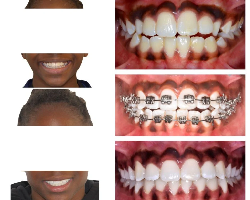 cas clinique orthodontiste rungis Photos cas avant/après Dr Kévin MAHOUN - Orthodontiste à Rungis