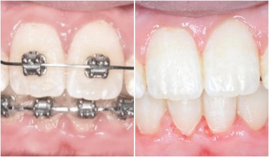 cas clinique orthodontiste cas cliniques Dr Kévin MAHOUN - Orthodontiste à Rungis