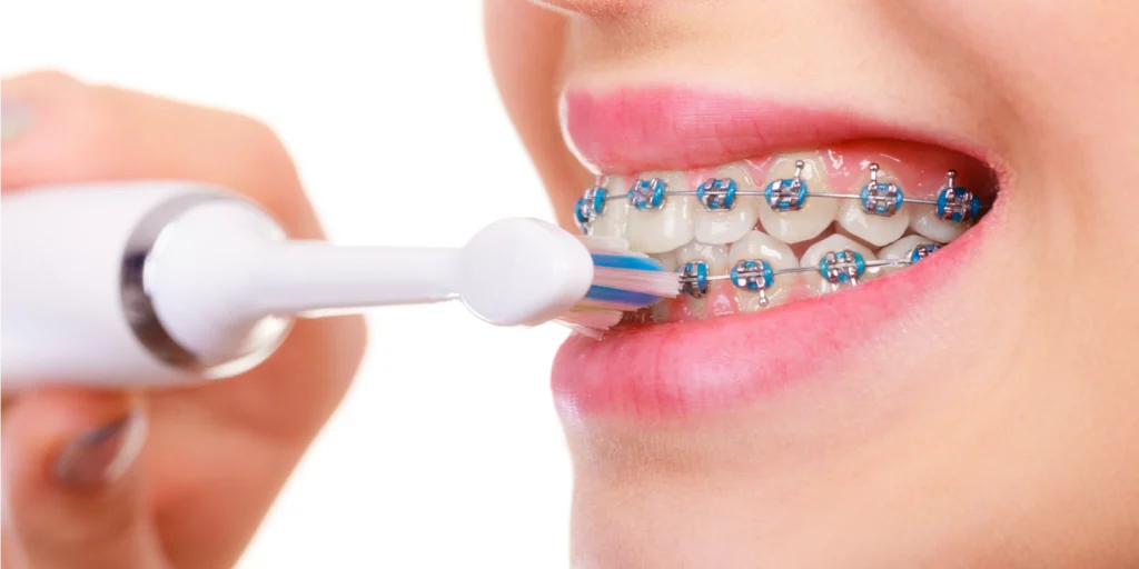 entretien aligneurs transparents Entretien des appareils Dr Kévin MAHOUN - Orthodontiste à Rungis