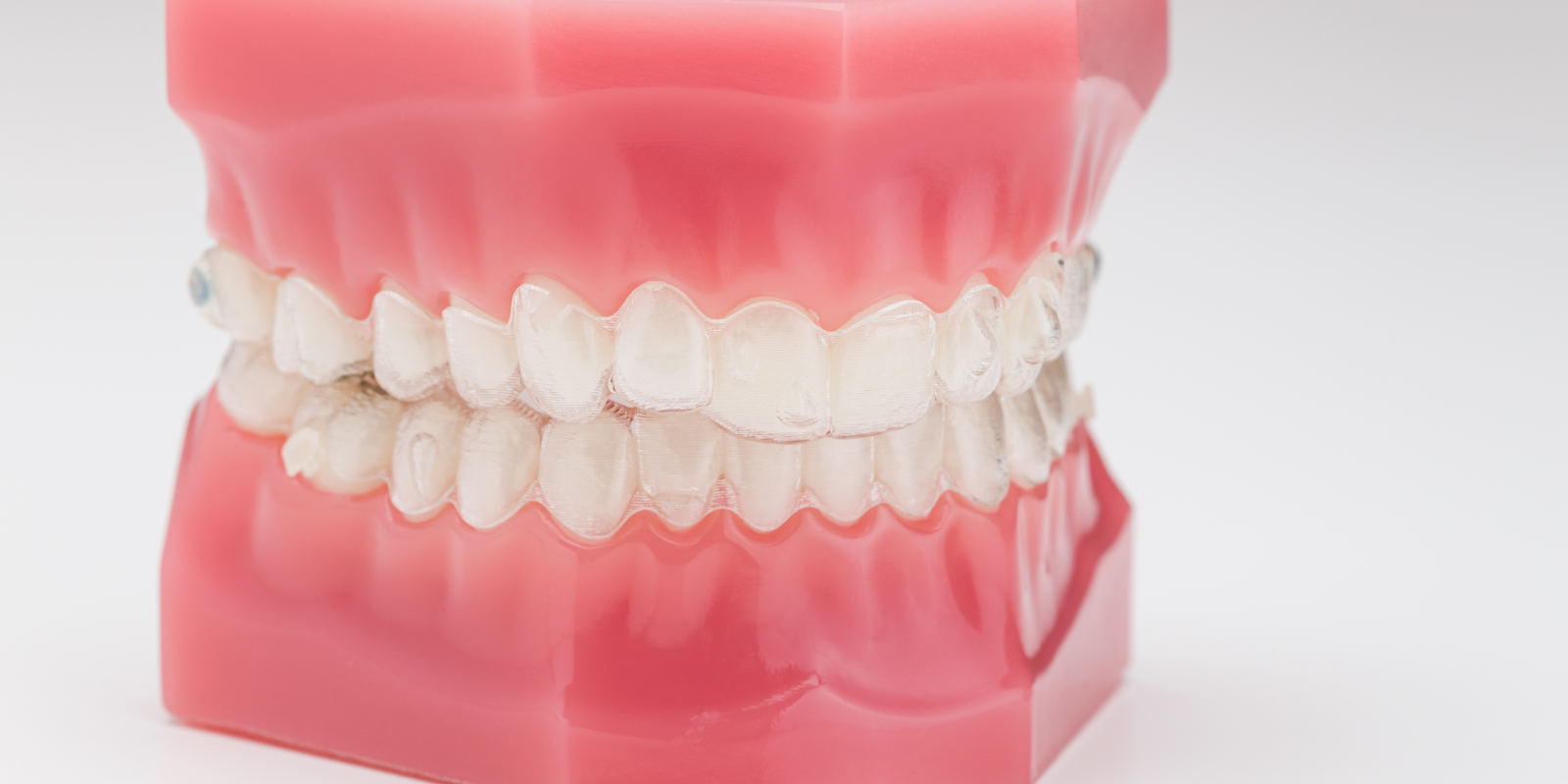 orthodontie invisible gouttieres transparents Orthodontie invisible Dr Kévin MAHOUN - Orthodontiste à Rungis